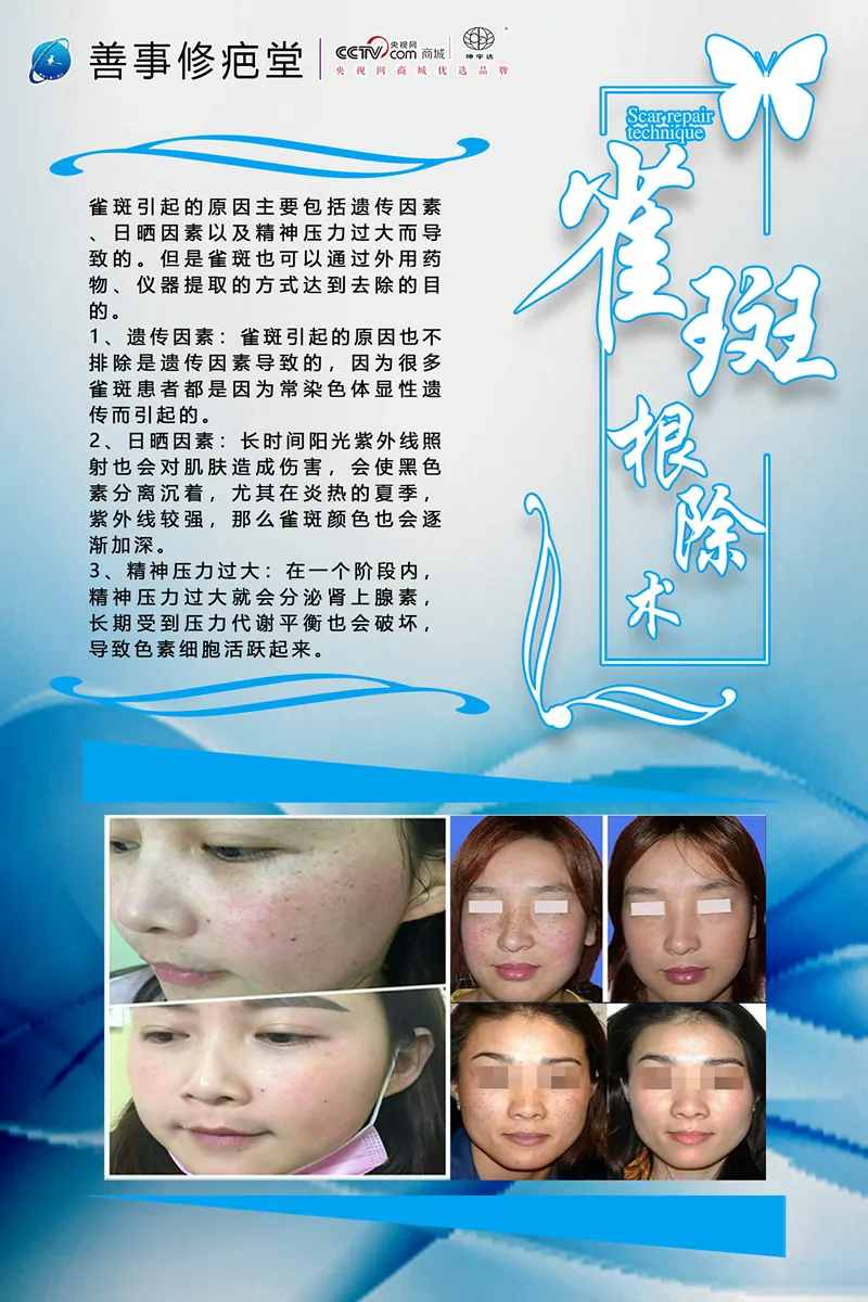 雀斑根除术